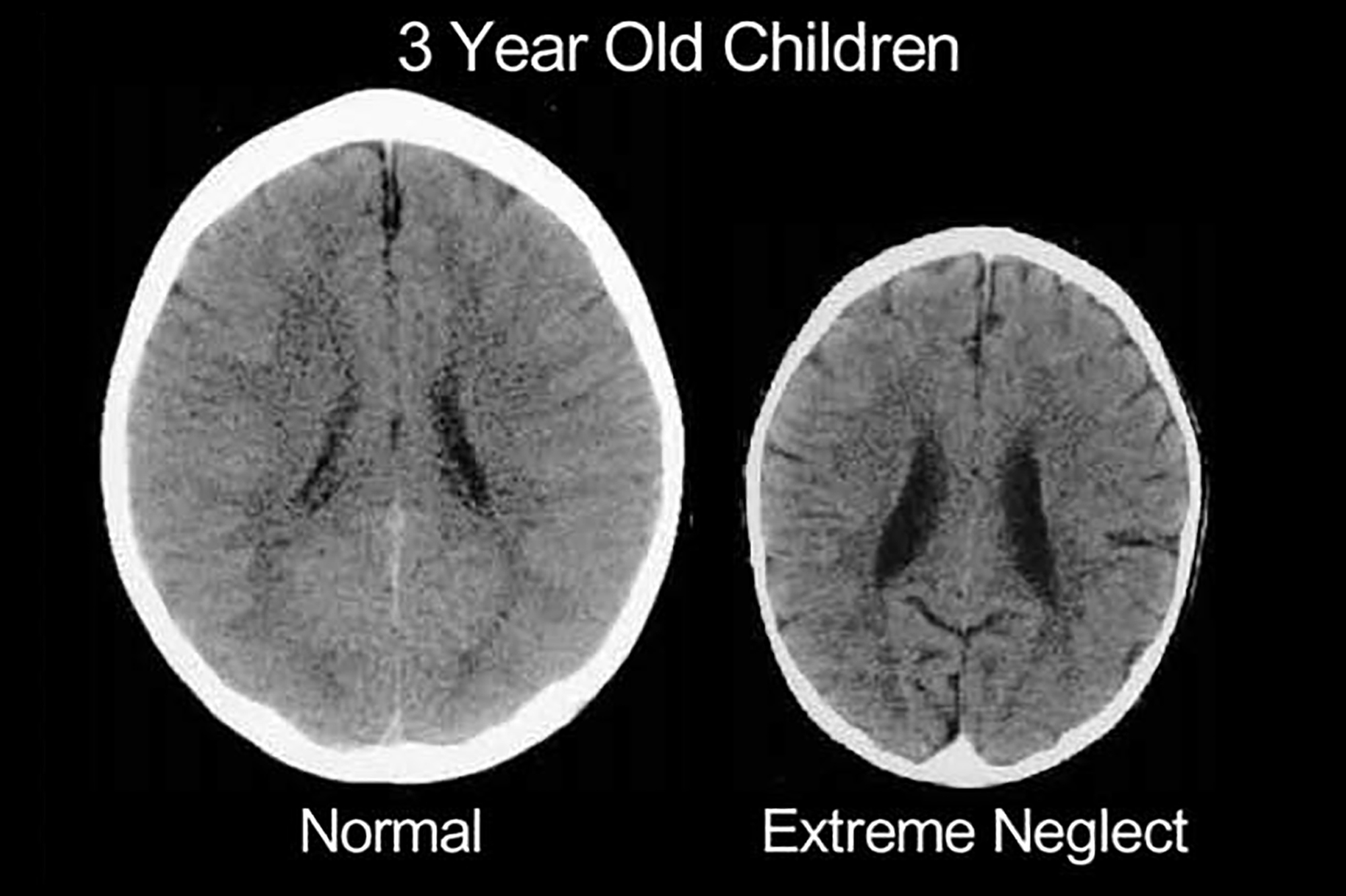 The CT scan on the left shows a normal child's brain, the one on the right is the brain of a child who has been the victim of emotional trauma.